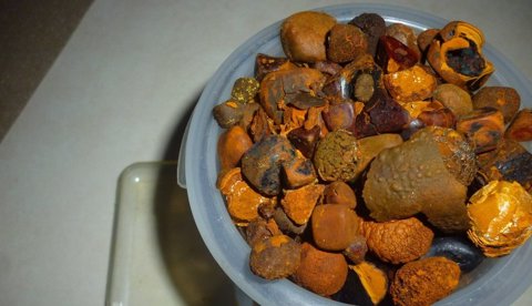 porq salen las piedras en la vesicula porq salen las piedras en la vesicula